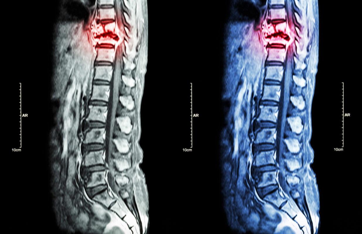 the-different-spinal-fracture-types-explained-decobizz-lifestyle-blog